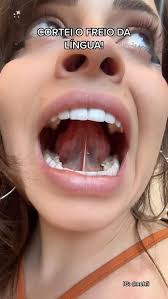 Influencer Rochelle Garett retira o freio da língua para corrigir língua  presa