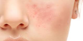 topical treatment to target rosacea