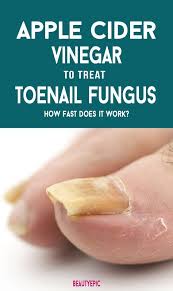 It has natural antifungal properties that can prevent toenail fungus from spreading. How To Prepare An Apple Cider Vinegar For Toenail Fungus Apple Cider Vinegar Remedies Toenail Fungus Nail Fungus Cure