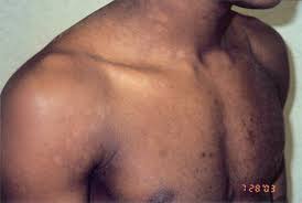 Apr 25, 2018 · pityriasis rubra pilaris is a rare skin disorder that causes skin inflammation and shedding. Pityriasis Versicolor Springerlink