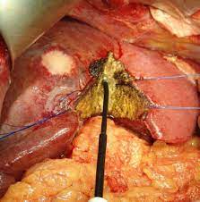 We did not find results for: The Aim Of Technology During Liver Resection A Strategy To Minimize Blood Loss During Liver Surgery Intechopen