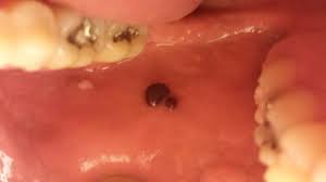 Flat blood blister inside cheek. Blisters Quotes Quotesgram