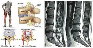 These are important slipped disc symptoms to note, to tell the. Slip Disc Treatment In Pune Dr Pallav Bhatia