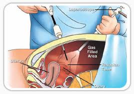 Diagnostic laparoscopy