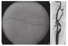 Nous vous expliquons comment les éliminer et les prévenir. Anomalie De La Vision D Apparition Brutale College Des Enseignants De Neurologie
