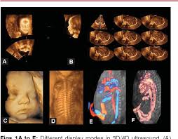 We did not find results for: Current Role Of 3d 4d Sonography In Obstetrics And Gynecology Semantic Scholar