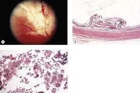 Does every necrotizing granulomatous inf. Granulomatous Inflammation Ento Key