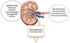 Image result for Postrenal Failure