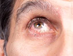 Image result for Uveitis