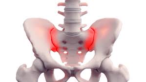 Image result for Sacroiliac Dysfunction