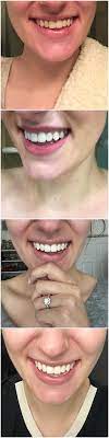 Can i use whitening strips with dental work? I Wore Crest Whitestrips For 14 Days And Here S What Happened