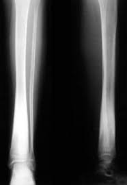 Image result for Osteomyelitis