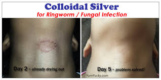 While the conventional veterinary health care system is proficient at treating disease, vets know very little about promoting and colloidal silver for cats is a wonderful natural remedy for a variety of conditions in our fur babies. How To S Wiki 88 How To Get Rid Of Ringworm On Neck