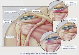 Treatment depends on which tendon you ruptured and how severe the rupture is. Reparation De La Coiffe Des Rotateurs Dr Pierre Yves Durand