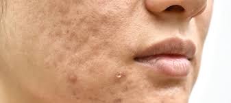 Image result for acne face