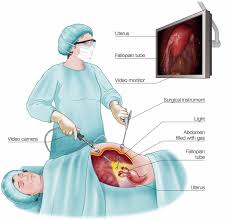 Laparotomy Surgery Exploratory Laparotomy Or Open Laparotomy Procedure Endometriosis Surgery Laproscopic Surgery Laparoscopic Surgery