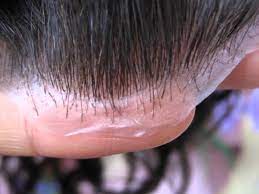 Complete Hair Solutions Co Uk Affordable Non Surgical Hair Replacement Mr Blue Sky Hair Replacement Systems Help Hair Loss Hair Replacement