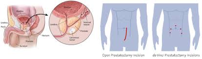 Image result for Radical Prostatectomy