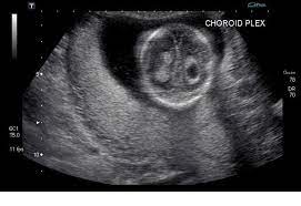 Wk 6 L 2 Choroid Plexus Cyst Radiology Case Radiopaedia Org Diagnostic Medical Sonography Plexus Products Ultrasound