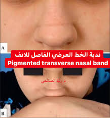 We did not find results for: Ø¯ ÙˆÙ„ÙŠØ¯ Ø§Ù„ØµØ§Ù„Ø­ÙŠ Twitterren Ù†Ø¯Ø¨Ø© Ø£Ùˆ Ø§Ù„Ø®Ø· Ø§Ù„Ø¹Ø±Ø¶ÙŠ Ø§Ù„ÙØ§ØµÙ„ Ù„Ù„Ø§Ù†Ù Pigmented Transverse Nasal Band Ù‡Ùˆ Ø®Ø· ØµØ¨ØºÙŠ Ø§Ùˆ Ø§Ù†ÙƒØ³Ø§Ø± Ø¬Ù„Ø¯ÙŠ Ø¨Ø¹Ø±Ø¶ Ø§Ù„Ø§Ù†Ù Ø¨Ø³Ø¨Ø¨ Ø¶ØºØ· Ø§Ù„Ø§Ù†Ù Ø¨Ø·Ø±ÙŠÙ‚Ø© Ø¹Ù…ÙˆØ¯ÙŠØ© Ù…ØªÙƒØ±Ø±Ø© Ù…Ù…Ø§ ÙŠØ¹Ø±Ø¶ Ø§Ù„Ø¬Ù„Ø¯ Ù„Ù„Ø§Ù†ÙƒØ³Ø§Ø± ÙˆØ§Ø­ÙŠØ§Ù†Ø§