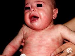 Image result for Atopic eczema atopic dermatitis