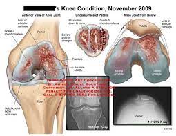 Learn about the veterinary topic of chondromalacia of the femoral condyles in horses. Medial Femoral Condyle Definition Of Medial Femoral Condyle By