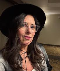 Is this lip filler migration four weeks after injection?