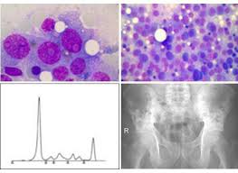 Multiples Myelom Und Amyloidose Medizinische Klinik Mit Schwerpunkt Hamatologie Onkologie Und Tumorimmunologie Cbf Charite Universitatsmedizin Berlin