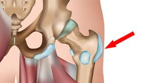 The first is when the it band snaps over the outside of the thigh. Pgup8dqjn4olwm