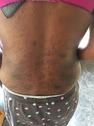 Skin cancer is the most common type of cancer in the united states by a pretty large margin, and it does not discriminate. Rashes Can Be A Better Sign Of Having Covid 19 Than Fever Or Cough Study Claims Mirror Online