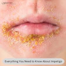 Image result for Impetigo