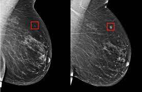 Dense breast tissue appears solid. Using Ai To Predict Breast Cancer And Personalize Care Mit News Massachusetts Institute Of Technology