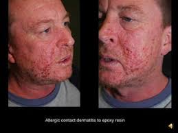 6. dermatitis and its variants