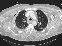 Although radiographs remain the mainstay for diagnosis and follow up of pneumothorax, computed tomography (ct) is increasingly being used for problem solving. Tension Pneumothorax Time To Change The Old Mantra Litfl