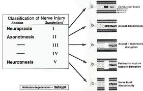 1 the lowest degree of nerve injury in which the nerve remains intact but signaling ability is. Classification And Wallerian Regeneration