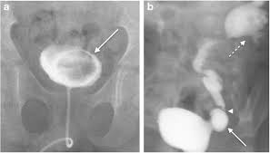 Image result for Voiding Cystourethrogram