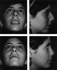 The Long Face Syndrome and Rhinoplasty