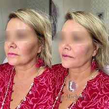 Facial restoration 💉💁🏼‍♀️ Any queries