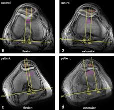 Image result for Patella Tracking Assessment
