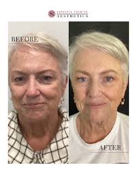 Ready for the ultimate skin transformation? This before and after features  a full-face approach using Genius RF microneedling, neurotoxin, dermal  fillers, IPL, and medical-grade skincare—aka the dream team of skin  rejuvenation. By