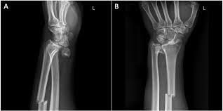 Image result for Scapholunate Dislocation