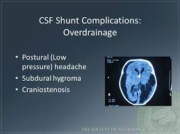 Emergency Evaluation Of Hydrocephalus Shunt Patients Ppt Video Online Download