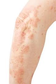 Image result for Skin Infection
