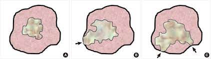 To establish the width of a margin, the pathologist will measure the distance between the outer edge of cancer cells and the edge of the tissue that was removed (the margin). Definitions Of Surgical Margin Status A Negative Surgical Margin Download Scientific Diagram