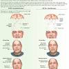 Bell's palsy is among the most common. Https Encrypted Tbn0 Gstatic Com Images Q Tbn And9gcqyitbfvwttnvcqvsk Lzb Zlkfc1vkdc4lvfj2eb0tapor5lka Usqp Cau