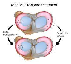 After arthroscopic meniscus surgery, most individuals should expect the rehabilitation process to last. Can A Meniscus Tear Heal Howard J Luks Md