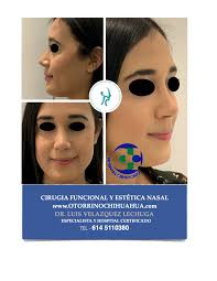 La rinoseptoplastia es una cirugia que mejora la función y el aspecto  nasal; se realiza de manera ambulatoria sin taponamiento en quirófano de  hospitales certificados en las manos capacitadas de un otorrinolaringologo