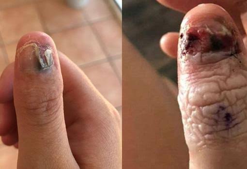 Resultado de imagen de Hombre termina con fuerte infección en el dedo por comerse las uñas"