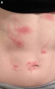 Image result for mite bites on humans