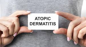 Dupilumab Shows Promise for Atopic Dermatitis in Skin of Color - Imagen principal del artículo